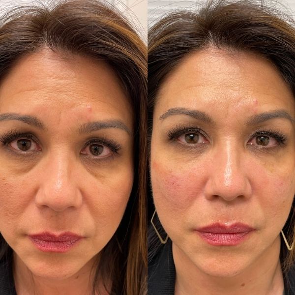 Velunella Haloxyl Eye Patches